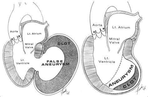 lv aneurysm ecg|lv pseudoaneurysm vs true aneurysm.